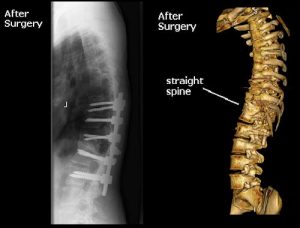 Complex Spine Surgery Melbourne | Spine Surgery Melbourne